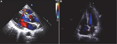 Case report: Total thoracoscopic repair of sinus of Valsalva aneurysm combined with ventricular septal defect